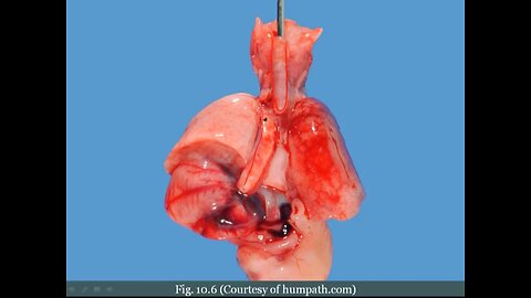 Esophagus Diseases