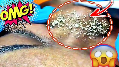 blackhead extration