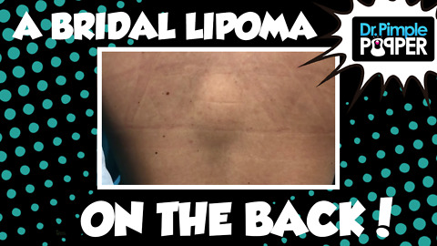 A Bridal Lipoma