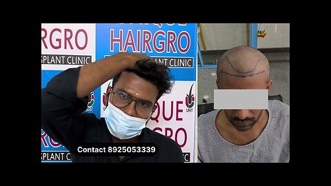 7 month Hair Transplant Before & after