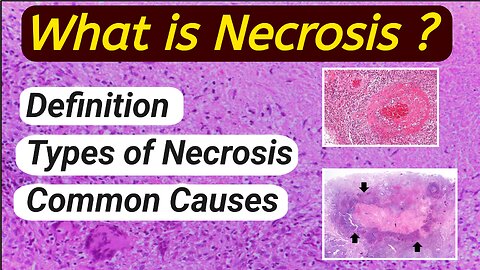 What is Necrosis | definition | Types of Necrosis| Pathology