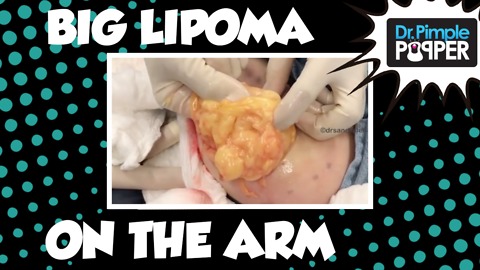 A HUGE Arm Lipoma removed by Dr Pimple Popper