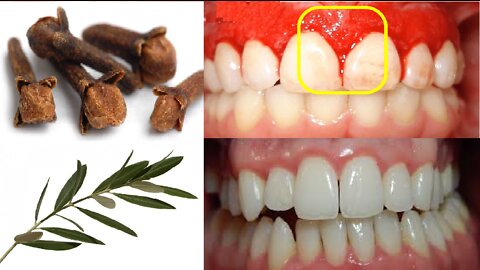 Best Natural Remedy for Inflamed Gums Say Goodbye to Bleeding Gums Gingivitis and Treat It Naturally