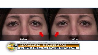 Plexaderm for fine lines