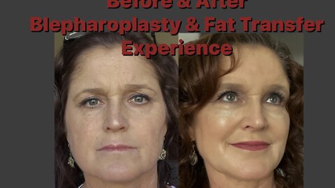 Before and after blepharoplasty journey