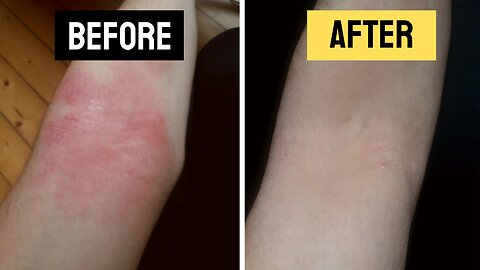 I healed my eczema... Here's how!