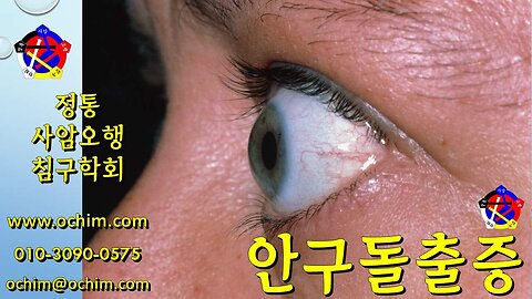 안구돌출증 치료 - 사암오행침, 사암침법, 오행침, 정통사암침