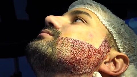 FUE Surgery_ Beard Transplant Amazing Results [Before-After]