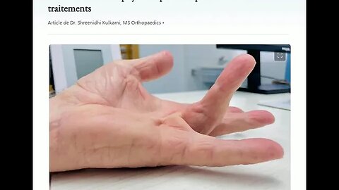 Contracture de Dupuytren: qu'est-ce que c'est et les traitements