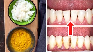 How To Remove Tartar And Plaque From Your Teeth Without A Dentist