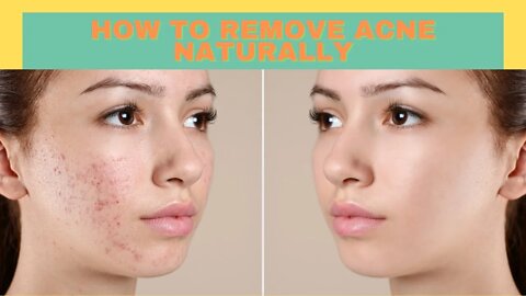 HOW TO REMOVE ACNE NATURALLY