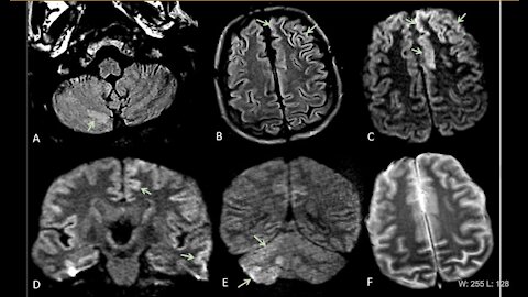 57% Of Spanish Covid Patients In Albacete Develop neurological disorders