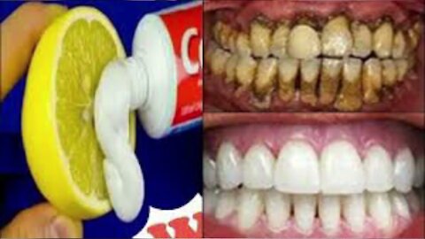 Home remedy In 2 minutes for teeth whitening yellow will make dirty teeth white like pearl and shiny