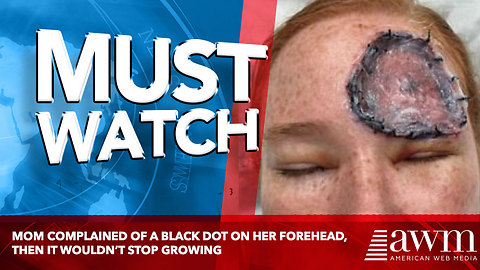 Mom Complained Of A Black Dot On Her Forehead, Then It Wouldn’t Stop Growing