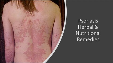 Psoriasis - Supplements, Herbs & Vitamins