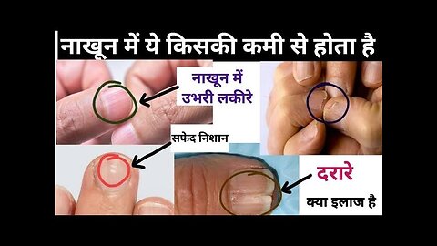 नाखून देखकर बीमारी का कारण जाने - Nail Examination