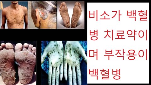 돌팔이 의학의 역사, 리디아 강, 네이트페더슨, 비소, 유산 상속을 위한 가루, 쥐약을 먹은, 매독구원자, 정말 비소를 백혈병 치료제로 쓰고 있음, 이상반응이 백혈구 증가증