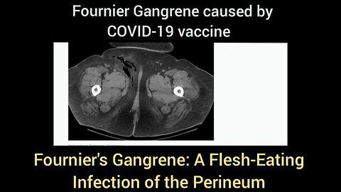 Fournier Gangrene - caused by Covid-19 Vaccine 💉☠️💉