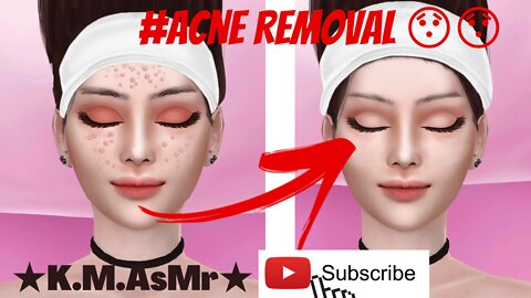 ACNE REMOVAL... 😳😳