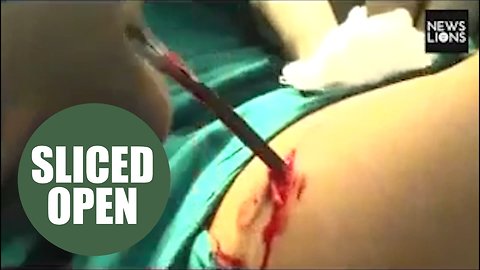 Moment doctors pulled a five inch blade from a stab victim's back