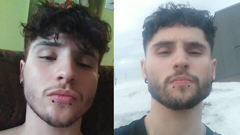 Minoxidil 10 Months Before & After What They Don't Say!?