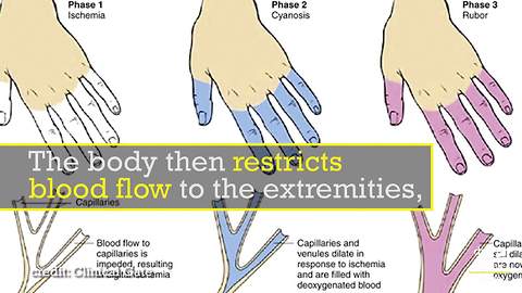 The Mysterious Raynaud's Disease