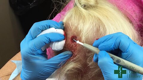 Removal of Squamous Cell Cancer on the Scalp