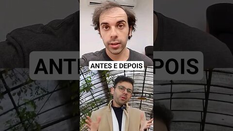 Transplante capilar fue, antes e depois no Brasil