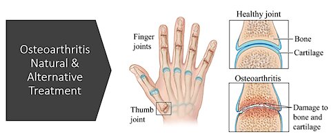 Osteoarthritis - Natural & Alternative Treatment