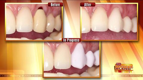 Get New Dental Crowns in Just an Hour