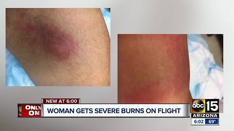 Woman says she was severely burned on a Southwest Airlines flight from Phoenix