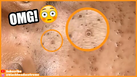 Blackheads Removal On Lady's Face (Oddly Satisfy)