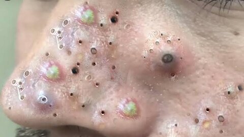 popping Huge Blackheads And Pimple Popping - Satisfying Popping Video