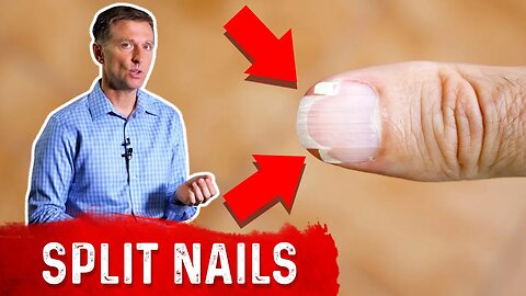 What's Lacking With Split Nails