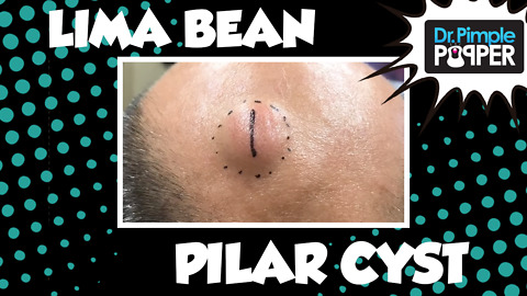 A Lima Bean Pilar Cyst