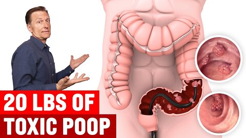 Do We REALLY Have 5 to 20 lbs of Toxic Poop in Our Colons?