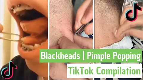 12 Minutes of Blackheads & Pimple Popping - TikTok Compilation #1