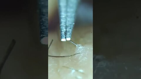 Ingrown hair removal weird satisfying 2022 tiktok