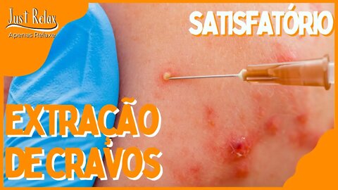 Satisfatório Remoção de Cravos - Remove Cravos e Espinhas Asmr - Just Relax | Apenas Relaxe