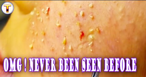 Treatment removal big blackhead on face ance