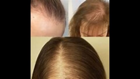 Best hair loss solution**Folisin Hair Loss