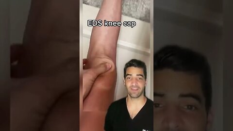 Knee cap hypermobility, EDS