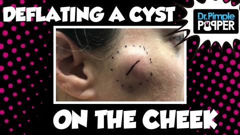 Deflating a Cyst on the Cheek