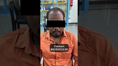 9 Months Hair Transplant Result