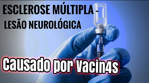 🚨❗ESCLEROSE MÚLTIPLA – LESÃO NEUROLÓGICA INDUZIDA POR VACINAS DE MRNA COVID-19