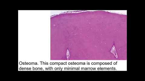 Oral pathology L15 part2 (Paget’s disease, Tumors, and Tumor-like lesions of Bone)