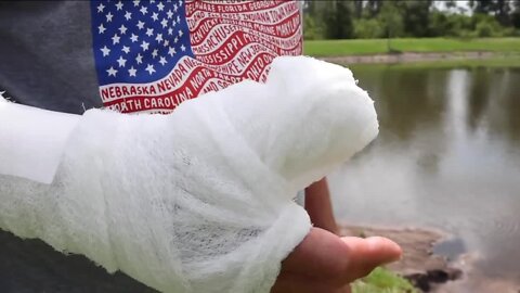 Pasco County man infected with "flesh-eating" bacteria through his thumb