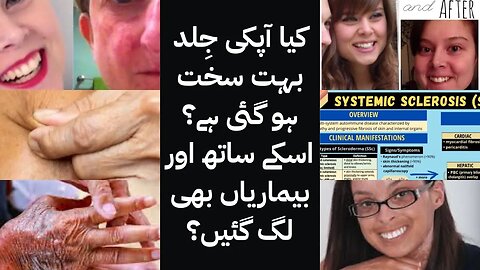 Scleroderma in Urdu