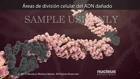 Radioterapia de intensidad modulada (RIM)