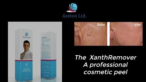 Seborrheic keratosis Removal using XanthRemover 70% Glycolic Acid Peel at home